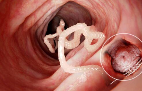 červ je parazit v ľudskom tele