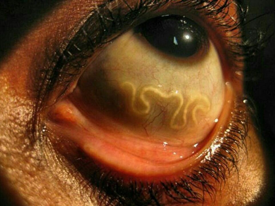 parazitov v ľudskom oku